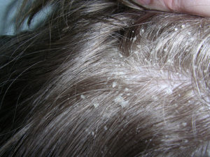 dandruff