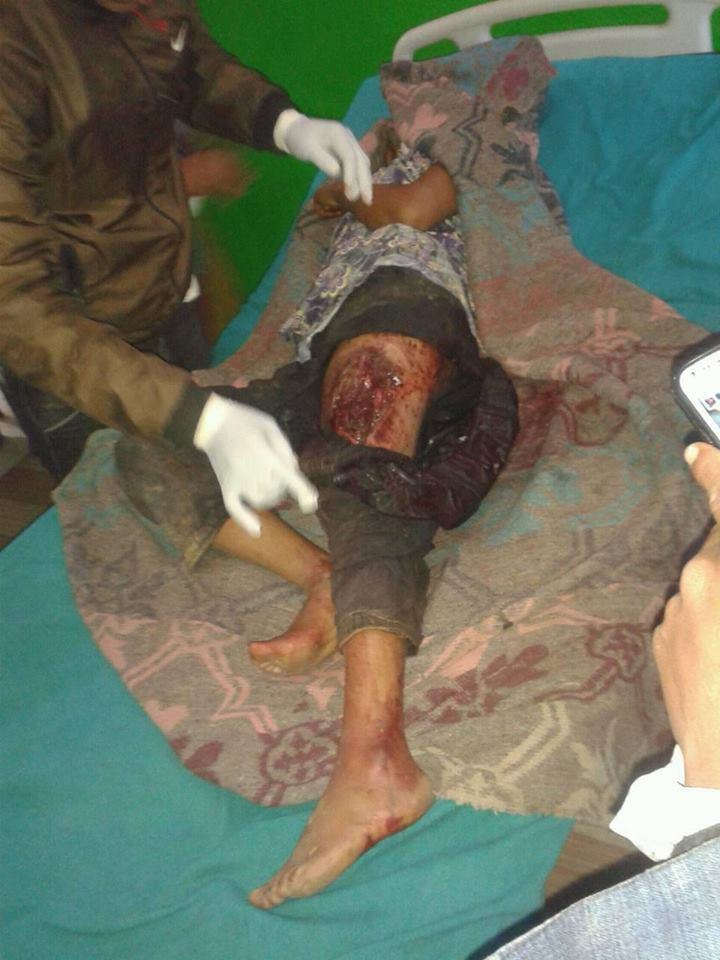 चट्याङ लागेर गुटूमा एक बालिका घाईते
